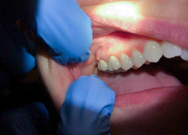 Best Emergency Root Canal Treatment in Aurora, IN